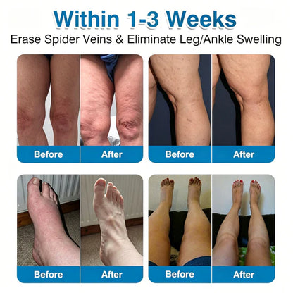🇨🇦👨‍⚕️✅GFOUK® VeinRepair Microneedle Patch Roll⚡Instant Relief, Long-Term Results