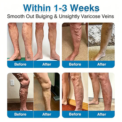 🇨🇦👨‍⚕️✅GFOUK® VeinRepair Microneedle Patch Roll⚡Instant Relief, Long-Term Results