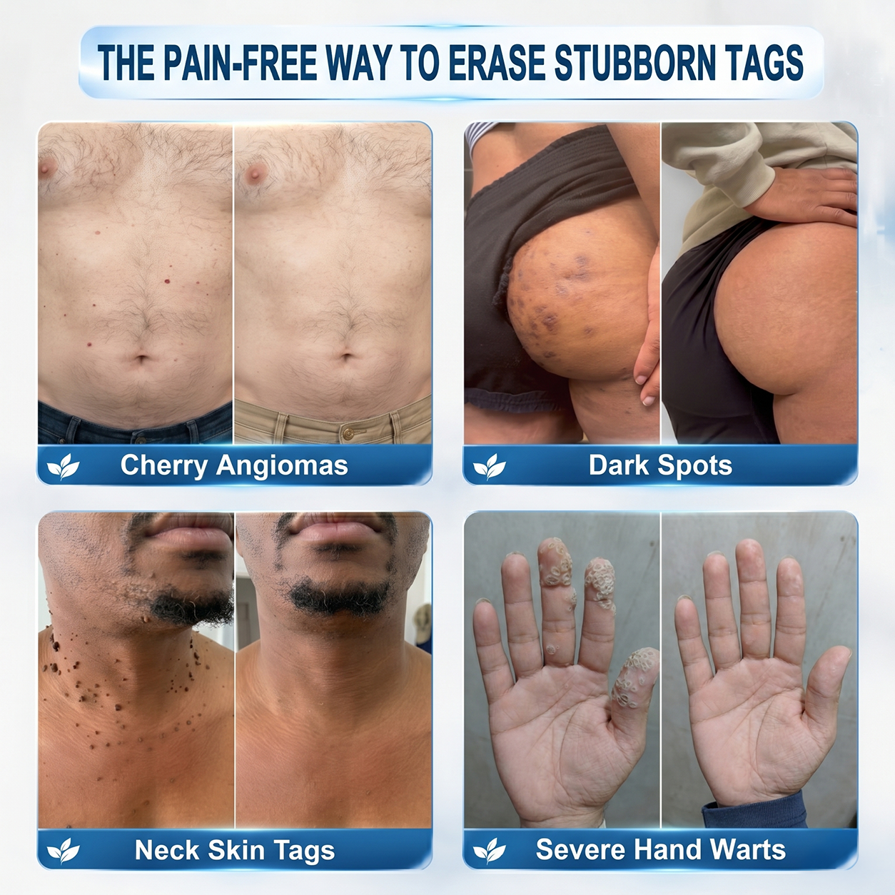 👩‍⚕️👍 𝐎𝐟𝐟𝐢𝐜𝐢𝐚𝐥 𝐒𝐭𝐨𝐫𝐞 | 𝑵𝐞𝒌𝐢𝐬𝐬® 🌿 𝐁𝐨𝐭𝐚𝐧𝐢𝐜𝐚𝐥 𝐌𝐢𝐜𝐫𝐨𝐧𝐞𝐞𝐝𝐥𝐞 𝐇𝐲𝐝𝐫𝐨𝐜𝐨𝐥𝐥𝐨𝐢𝐝 𝐏𝐚𝐭𝐜𝐡 (𝐅𝐨𝐫 𝐒𝐤𝐢𝐧 𝐓𝐚𝐠𝐬, 𝐒𝐦𝐚𝐥𝐥 𝐒𝐤𝐢𝐧 𝐆𝐫𝐨𝐰𝐭𝐡𝐬, 𝐖𝐚𝐫𝐭𝐬, 𝐌𝐨𝐥𝐞𝐬, 𝐀𝐠𝐞 𝐒𝐩𝐨𝐭𝐬 & 𝐏𝐢𝐠𝐦𝐞𝐧𝐭𝐚𝐭𝐢𝐨𝐧 𝐂𝐨𝐧𝐜𝐞𝐫𝐧𝐬)