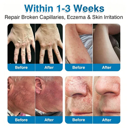 🇨🇦👨‍⚕️✅GFOUK® VeinRepair Microneedle Patch Roll⚡Instant Relief, Long-Term Results